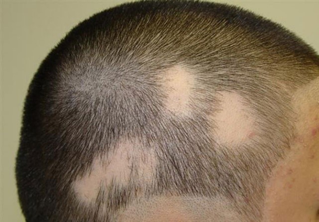alopecija